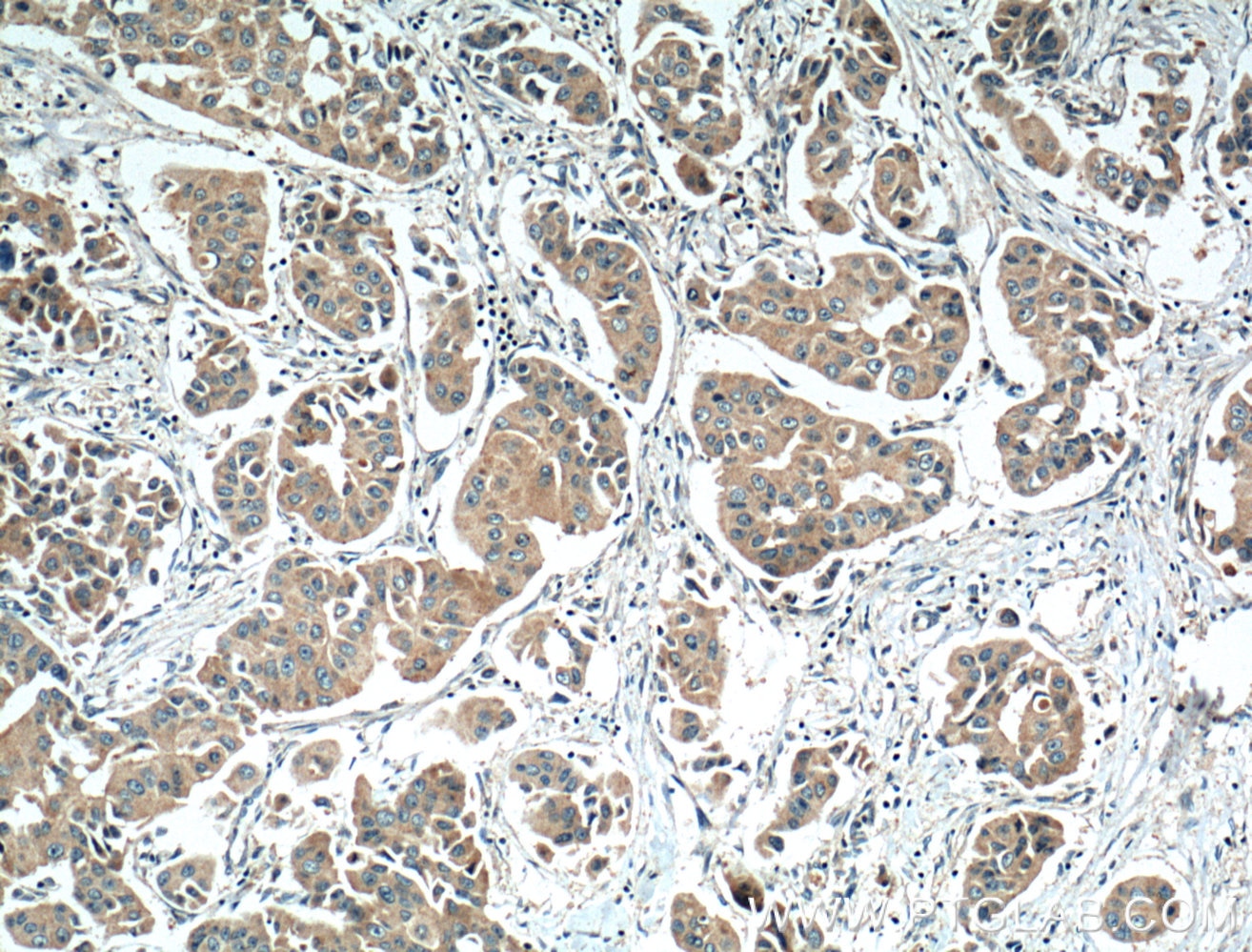 Immunohistochemistry (IHC) staining of human breast cancer tissue using MKNK2 Polyclonal antibody (17354-1-AP)