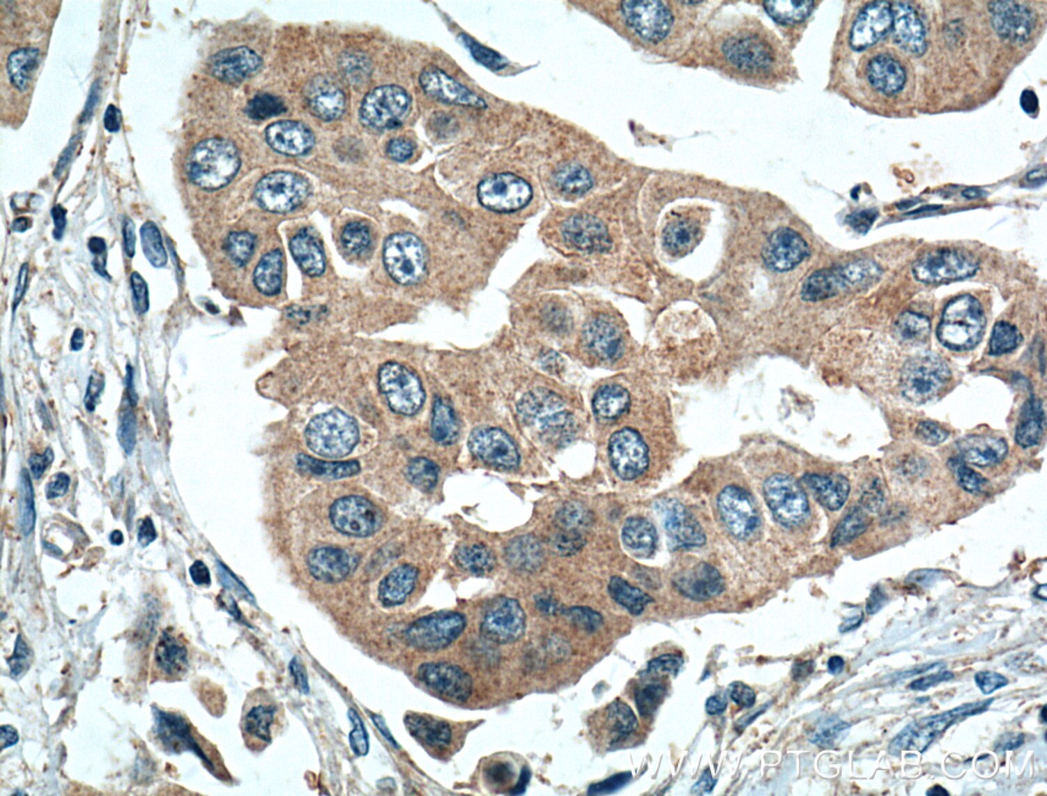 Immunohistochemistry (IHC) staining of human breast cancer tissue using MKNK2 Polyclonal antibody (17354-1-AP)