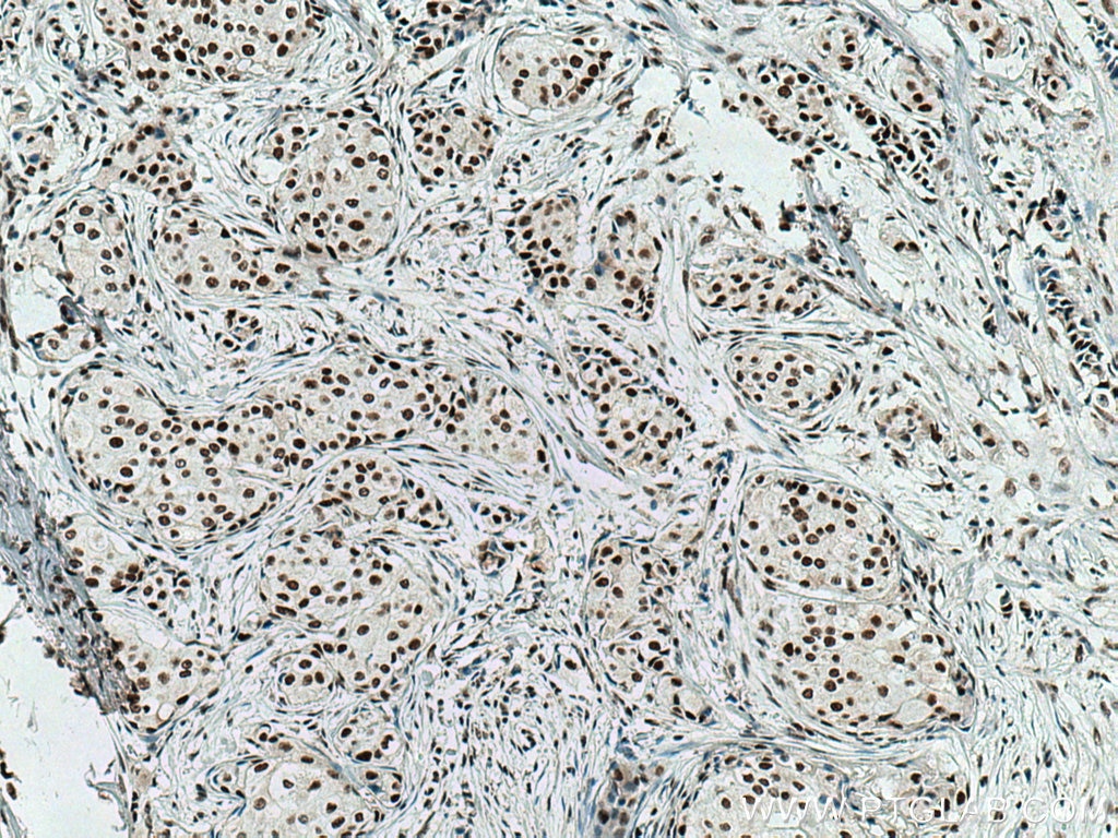Immunohistochemistry (IHC) staining of human breast cancer tissue using MKP-2 Monoclonal antibody (66349-1-Ig)