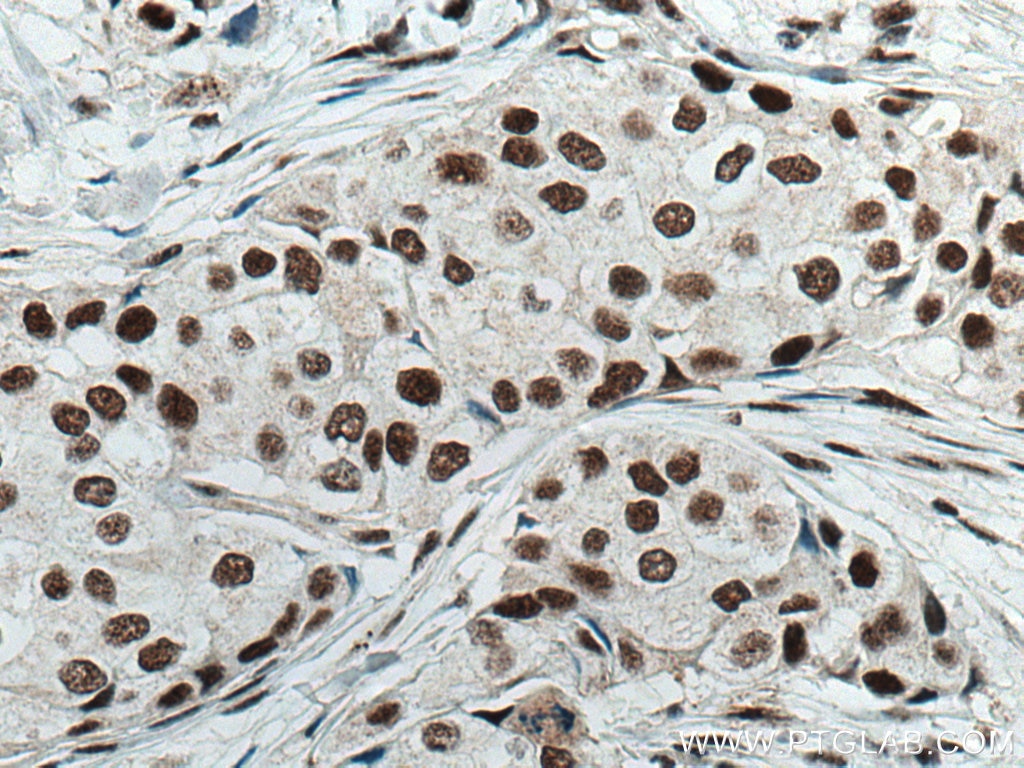 Immunohistochemistry (IHC) staining of human breast cancer tissue using MKP-2 Monoclonal antibody (66349-1-Ig)