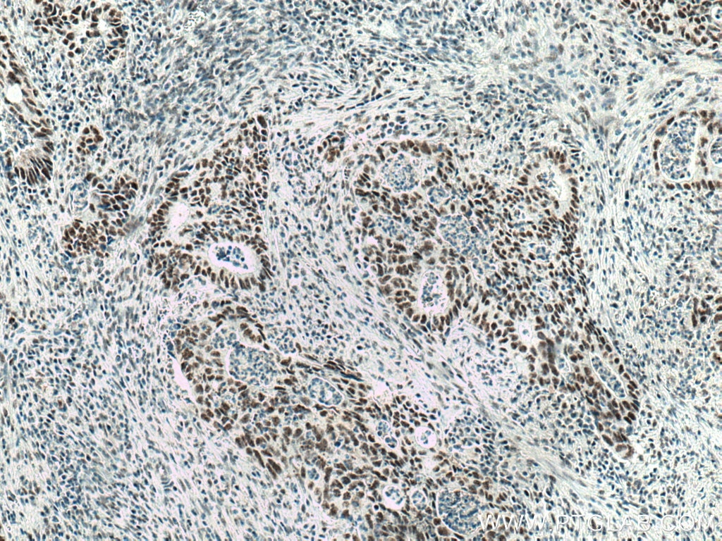 Immunohistochemistry (IHC) staining of human colon cancer tissue using MKP-2 Monoclonal antibody (66349-1-Ig)