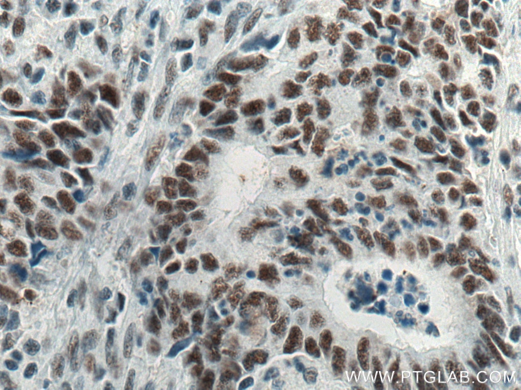 Immunohistochemistry (IHC) staining of human colon cancer tissue using MKP-2 Monoclonal antibody (66349-1-Ig)
