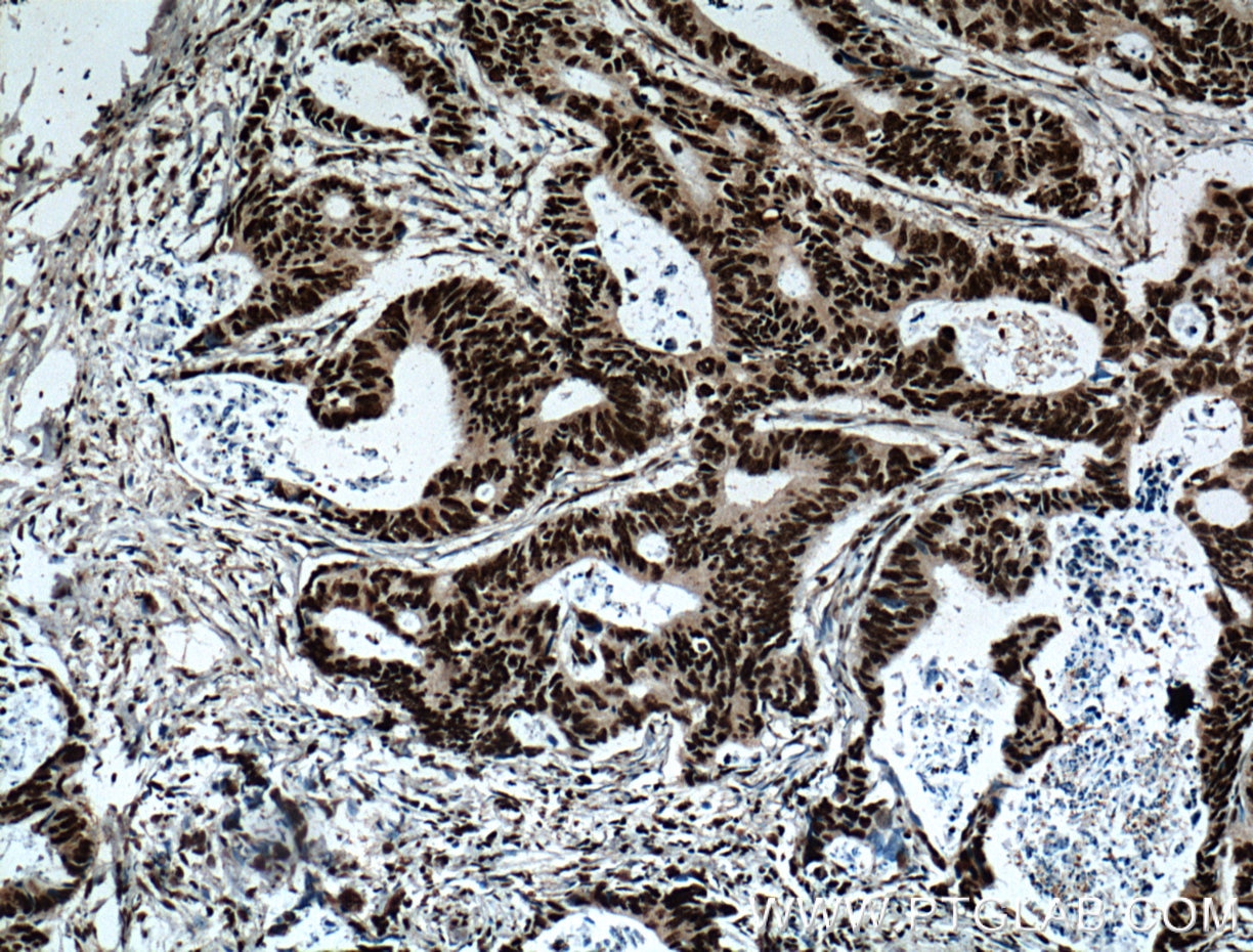 IHC staining of human colon cancer using 66349-1-Ig