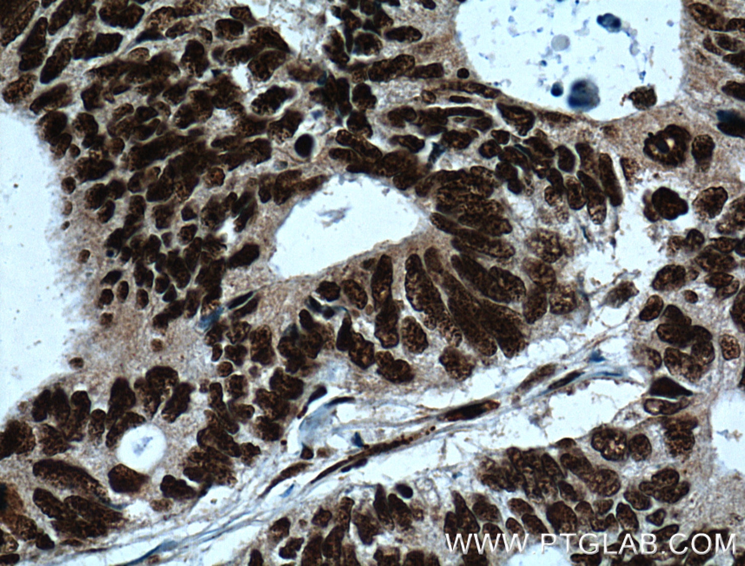 Immunohistochemistry (IHC) staining of human colon cancer tissue using MKP-2 Monoclonal antibody (66349-1-Ig)