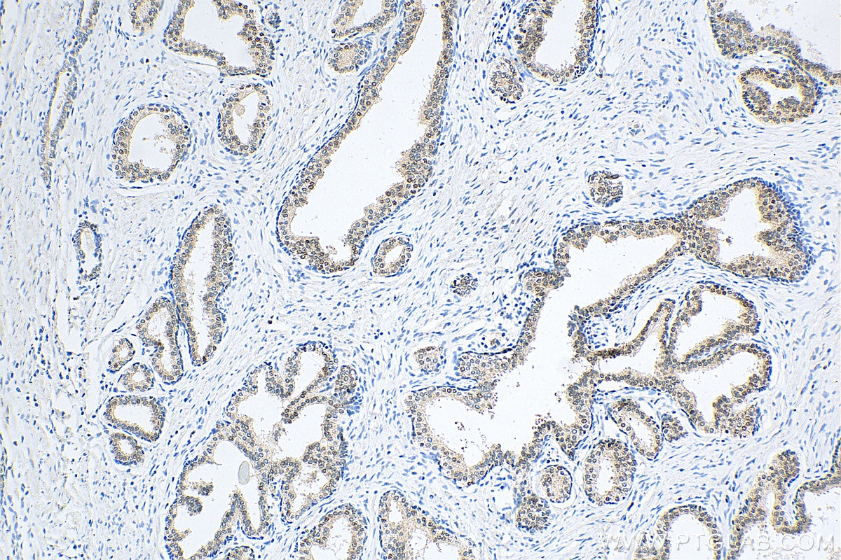 Immunohistochemistry (IHC) staining of human prostate cancer tissue using MKRN2 Polyclonal antibody (12238-1-AP)