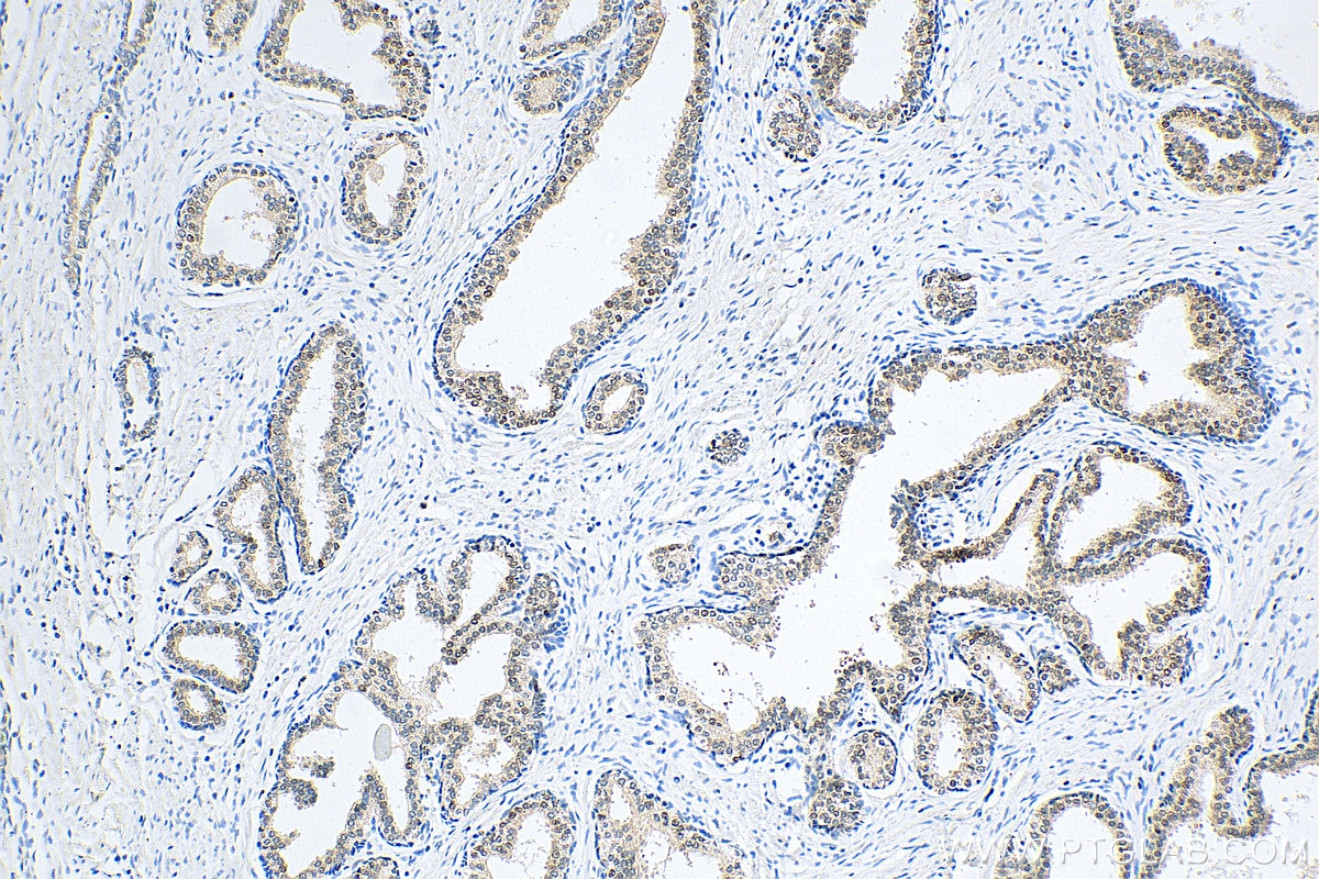 IHC staining of human prostate cancer using 12238-1-AP