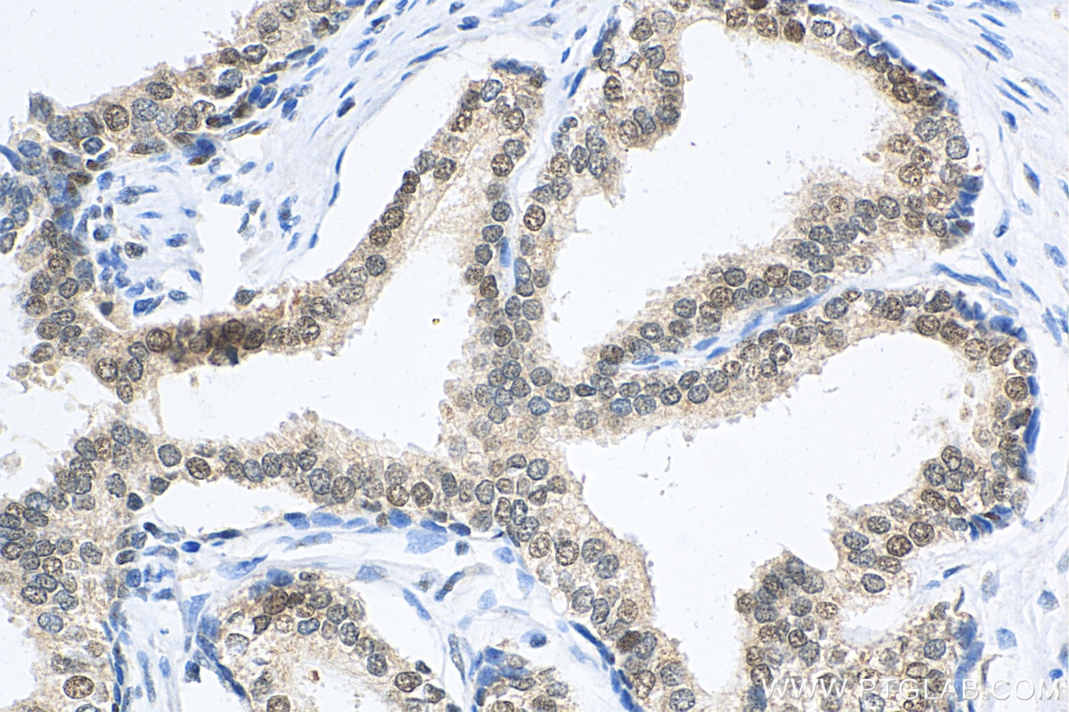 Immunohistochemistry (IHC) staining of human prostate cancer tissue using MKRN2 Polyclonal antibody (12238-1-AP)