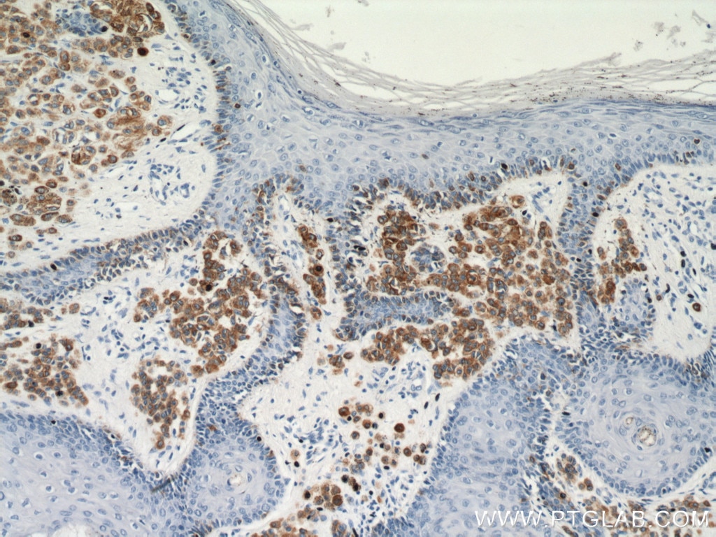 Immunohistochemistry (IHC) staining of human malignant melanoma tissue using Melan-A Polyclonal antibody (18472-1-AP)