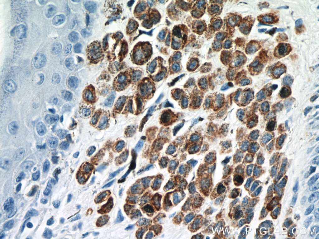 Immunohistochemistry (IHC) staining of human malignant melanoma tissue using Melan-A Polyclonal antibody (18472-1-AP)