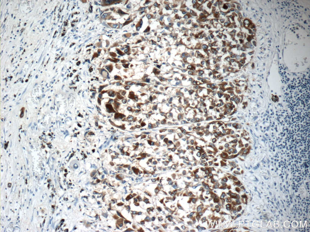 IHC staining of human malignant melanoma using 18472-1-AP