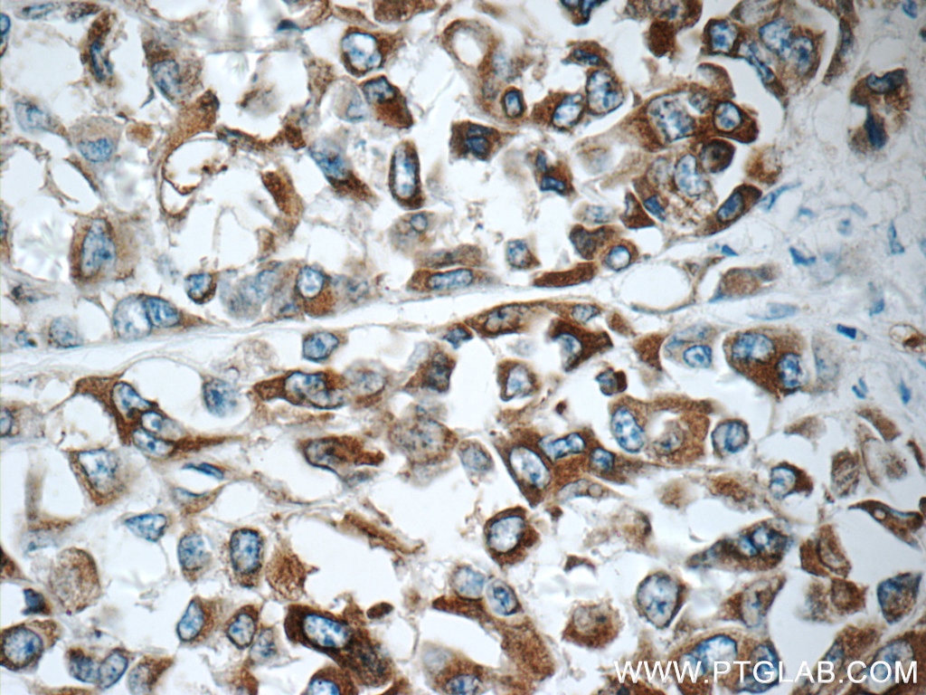 Immunohistochemistry (IHC) staining of human malignant melanoma tissue using Melan-A Polyclonal antibody (18472-1-AP)