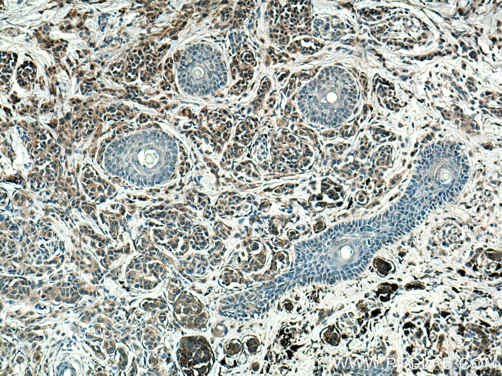 Immunohistochemistry (IHC) staining of human malignant melanoma tissue using Melan-A  Monoclonal antibody (60348-1-Ig)