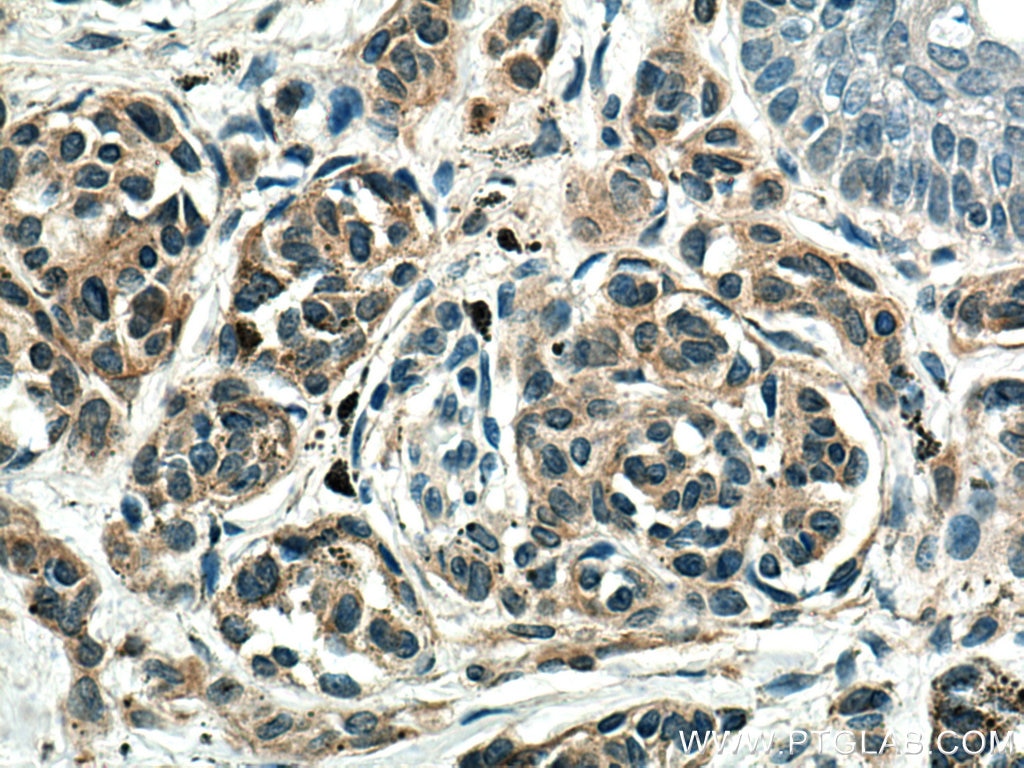 Immunohistochemistry (IHC) staining of human malignant melanoma tissue using Melan-A  Monoclonal antibody (60348-1-Ig)