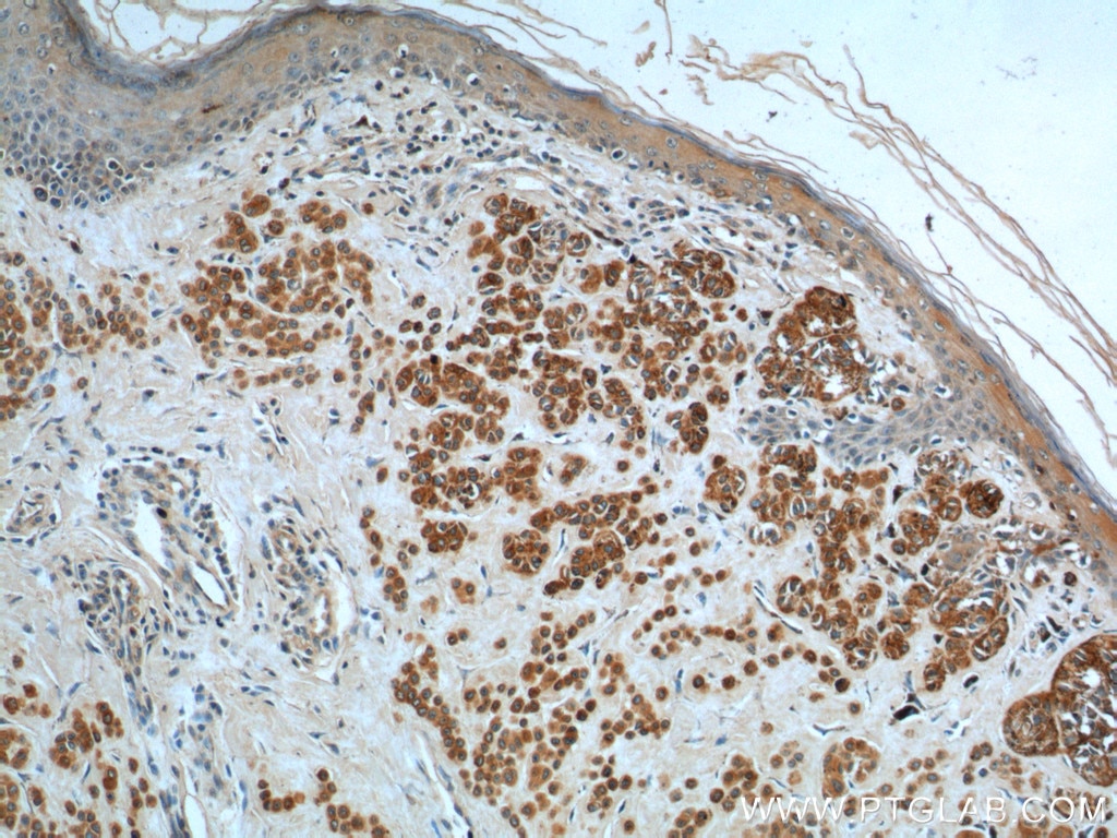 Immunohistochemistry (IHC) staining of human malignant melanoma tissue using Melan-A  Monoclonal antibody (60348-1-Ig)