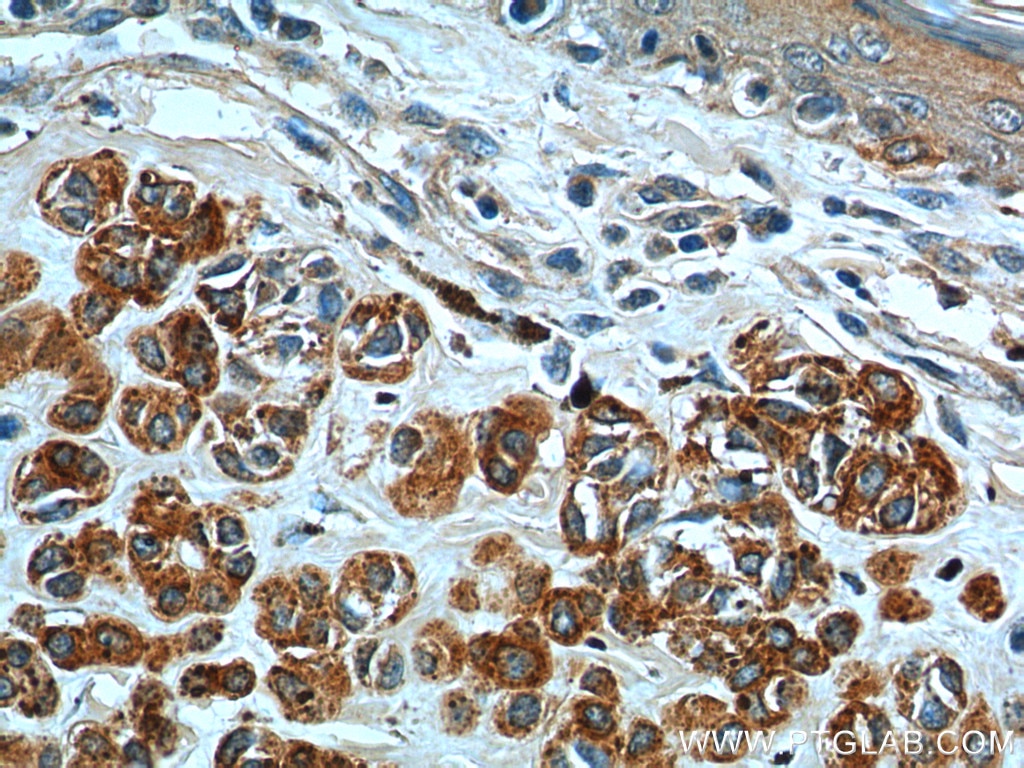 Immunohistochemistry (IHC) staining of human malignant melanoma tissue using Melan-A  Monoclonal antibody (60348-1-Ig)