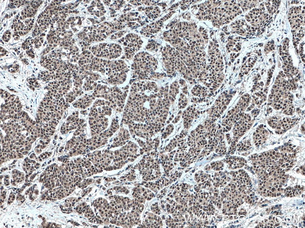 Immunohistochemistry (IHC) staining of human colon cancer tissue using MLF1 Polyclonal antibody (13100-1-AP)