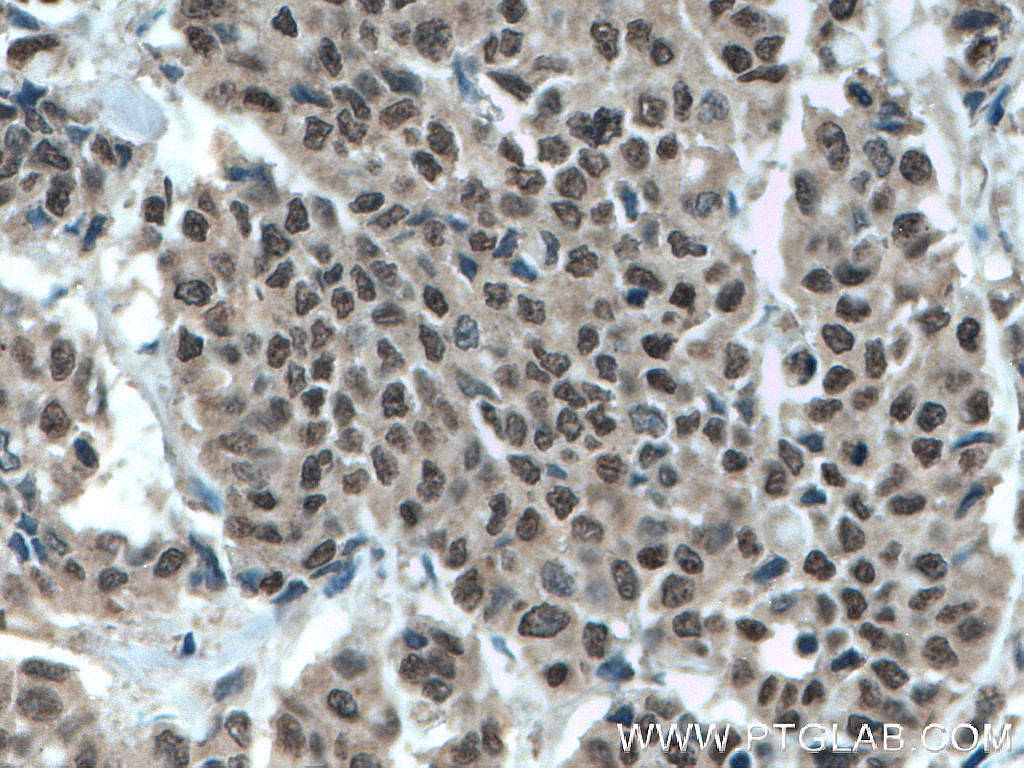 Immunohistochemistry (IHC) staining of human colon cancer tissue using MLF1 Polyclonal antibody (13100-1-AP)
