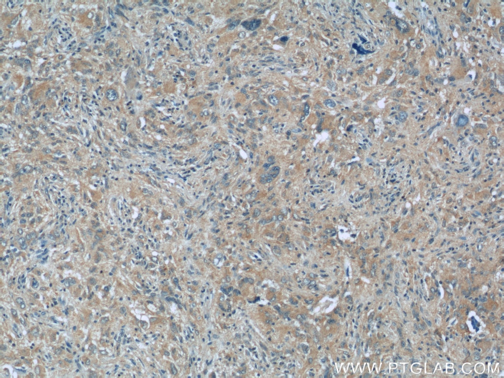 Immunohistochemistry (IHC) staining of human gliomas tissue using MLF1IP Polyclonal antibody (13186-1-AP)