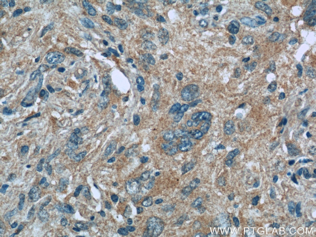 Immunohistochemistry (IHC) staining of human gliomas tissue using MLF1IP Polyclonal antibody (13186-1-AP)