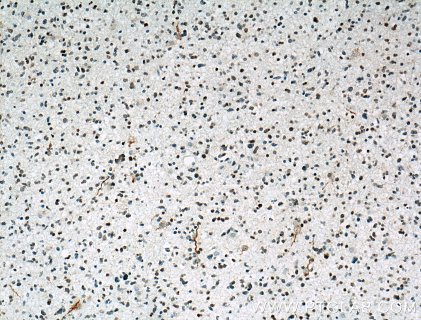 Immunohistochemistry (IHC) staining of human gliomas tissue using MLF2 Polyclonal antibody (11835-1-AP)