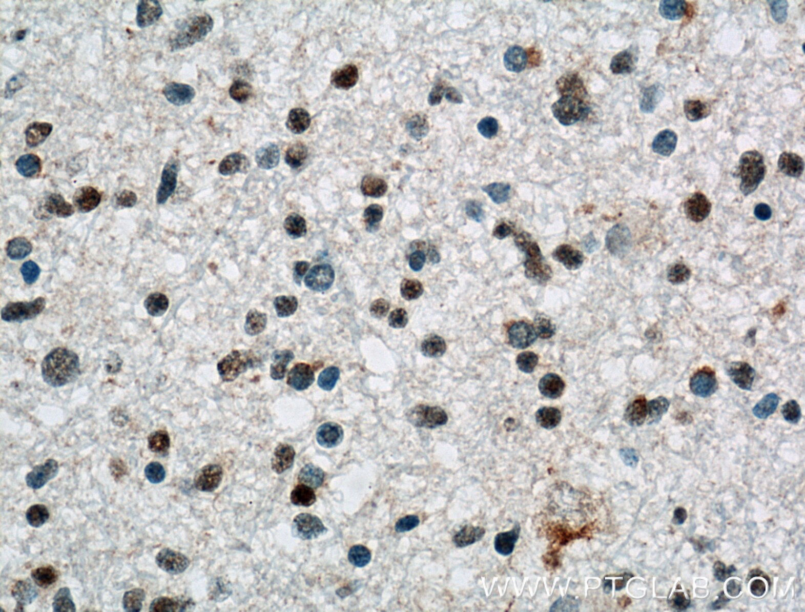 Immunohistochemistry (IHC) staining of human gliomas tissue using MLF2 Polyclonal antibody (11835-1-AP)