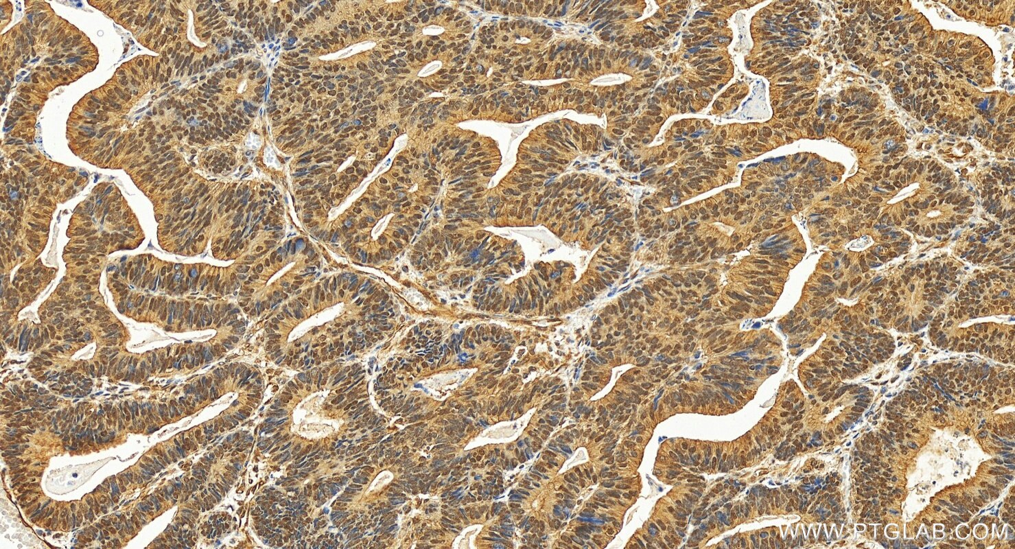 Immunohistochemistry (IHC) staining of human colon cancer tissue using MLH1 Polyclonal antibody (11697-1-AP)