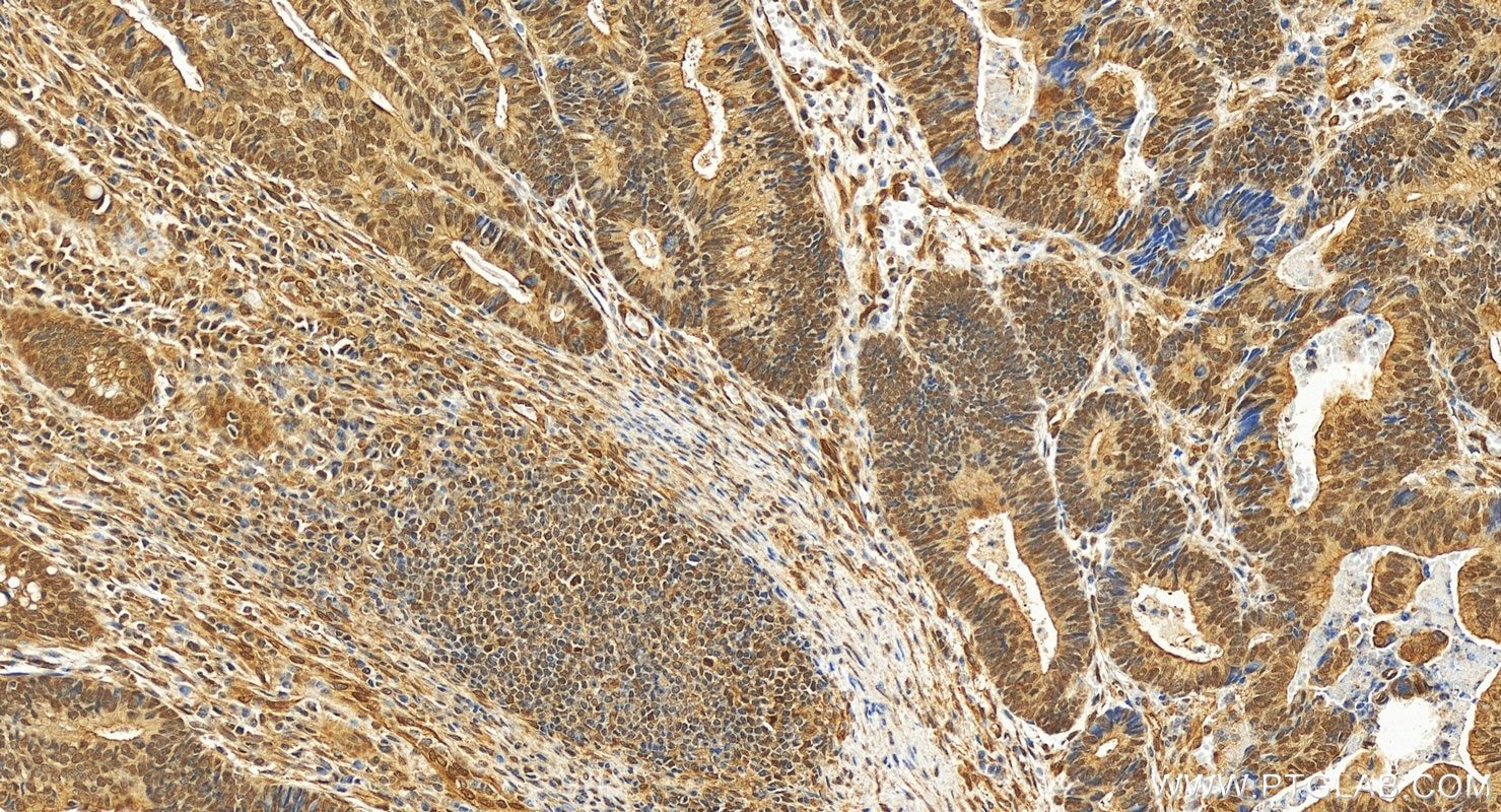 Immunohistochemistry (IHC) staining of human colon cancer tissue using MLH1 Polyclonal antibody (11697-1-AP)
