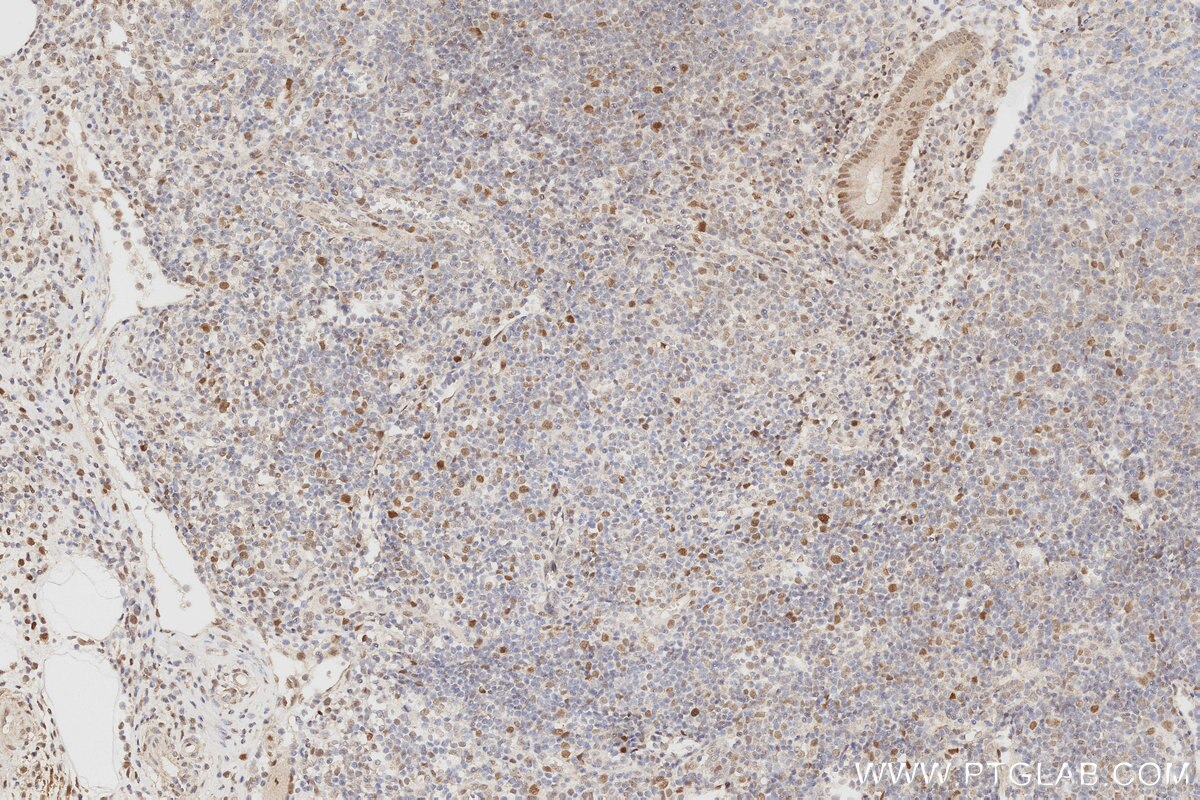 Immunohistochemistry (IHC) staining of human appendicitis tissue using MLH1 Monoclonal antibody (60822-2-Ig)