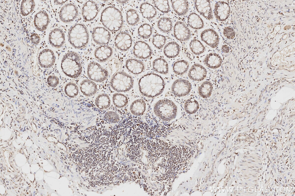 Immunohistochemistry (IHC) staining of human rectal cancer tissue using MLH1 Monoclonal antibody (60822-2-Ig)