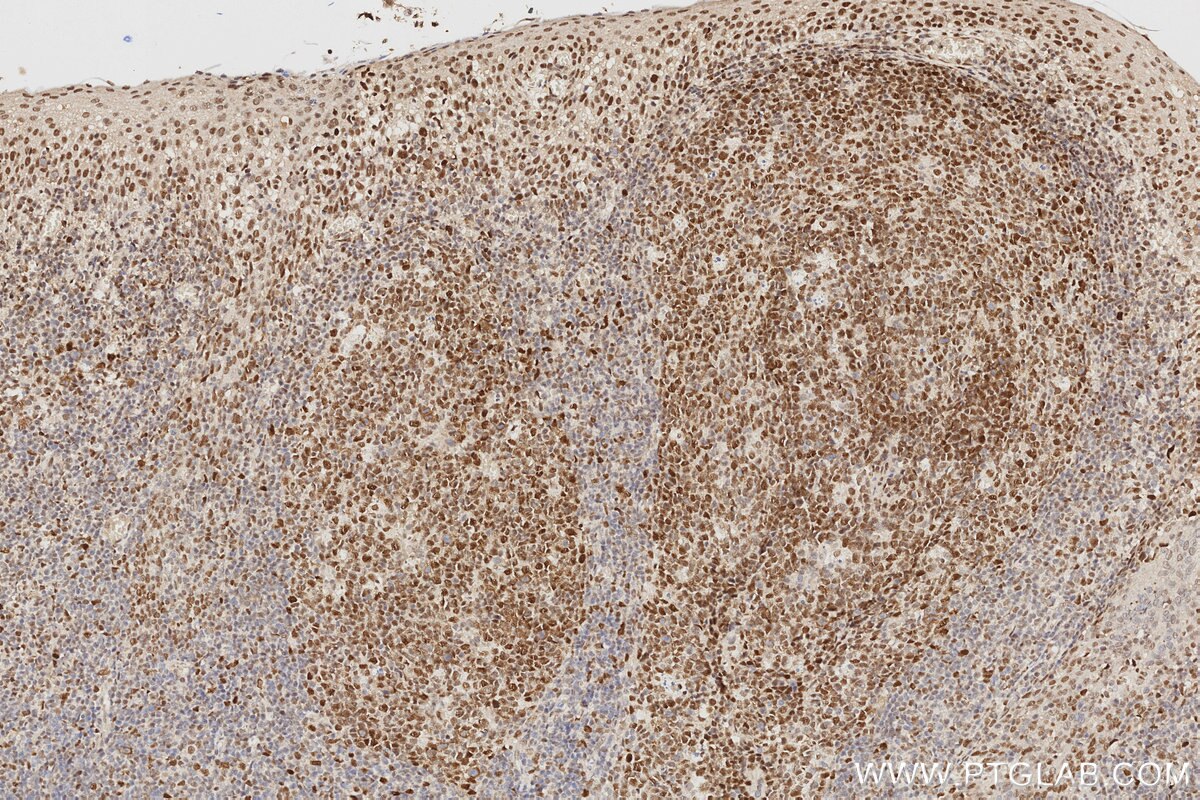 Immunohistochemistry (IHC) staining of human tonsillitis tissue using MLH1 Monoclonal antibody (60822-2-Ig)