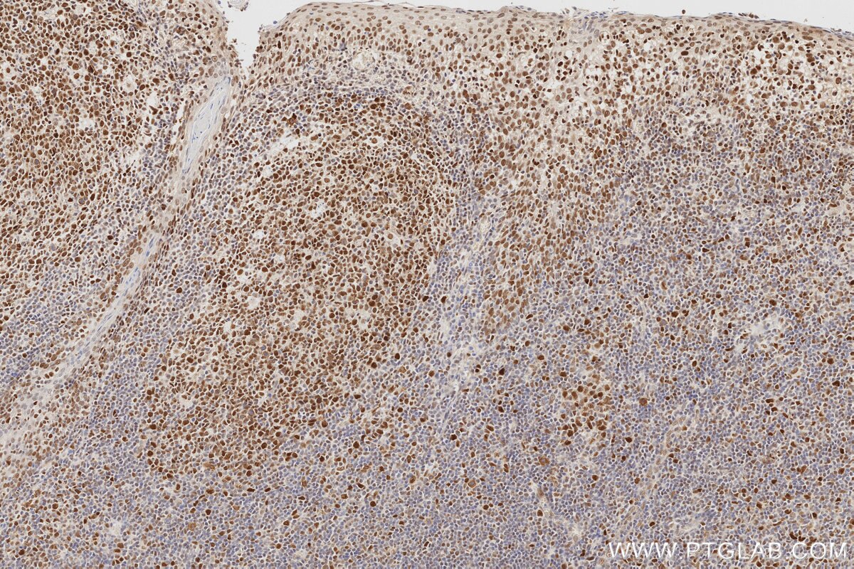 Immunohistochemistry (IHC) staining of human tonsillitis tissue using MLH1 Monoclonal antibody (60822-2-Ig)