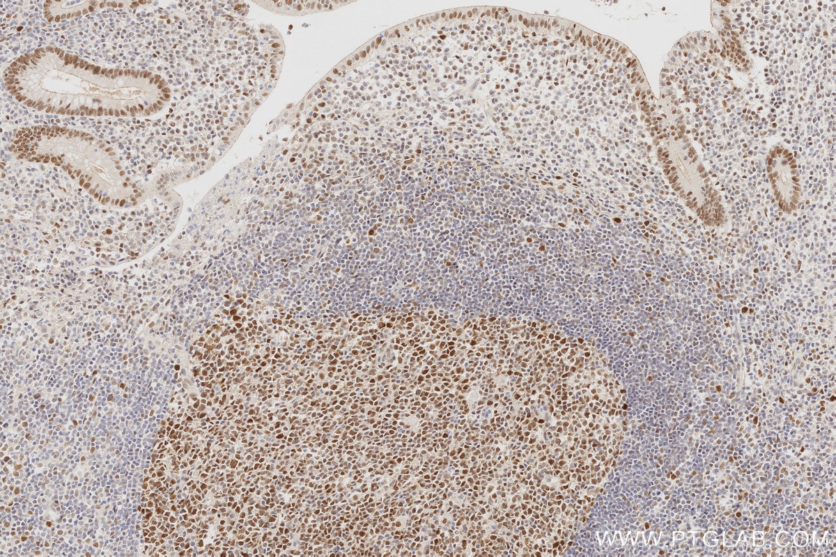 Immunohistochemistry (IHC) staining of human appendicitis tissue using MLH1 Monoclonal antibody (60822-2-Ig)