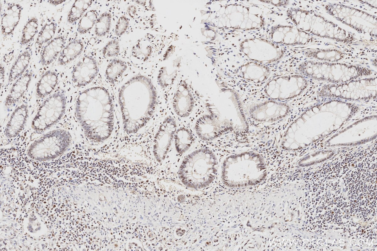 Immunohistochemistry (IHC) staining of human rectal cancer tissue using MLH1 Monoclonal antibody (60822-2-Ig)