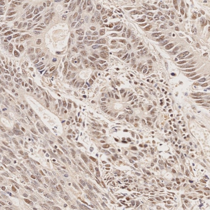 Immunohistochemistry (IHC) staining of human colorectal cancer tissue using MLH1 Monoclonal antibody (60822-2-Ig)