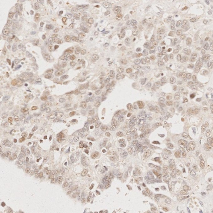Immunohistochemistry (IHC) staining of human ovary cancer tissue using MLH1 Monoclonal antibody (60822-2-Ig)