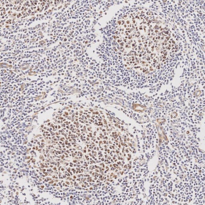 Immunohistochemistry (IHC) staining of human tonsillitis tissue using MLH1 Monoclonal antibody (60822-2-Ig)