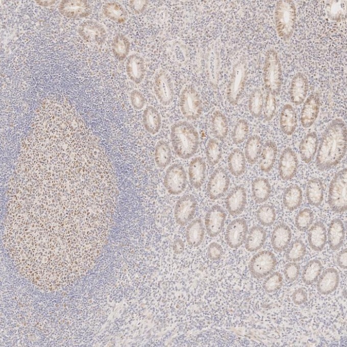 Immunohistochemistry (IHC) staining of human appendicitis tissue using MLH1 Monoclonal antibody (60822-2-Ig)