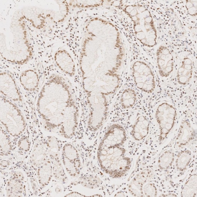 Immunohistochemistry (IHC) staining of human stomach cancer tissue using MLH1 Monoclonal antibody (60822-2-Ig)