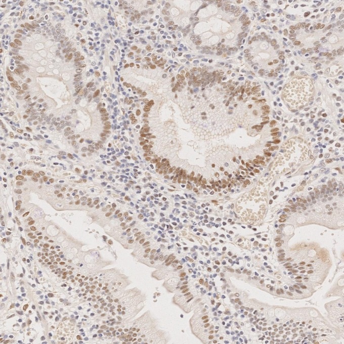 Immunohistochemistry (IHC) staining of human stomach cancer tissue using MLH1 Monoclonal antibody (60822-2-Ig)