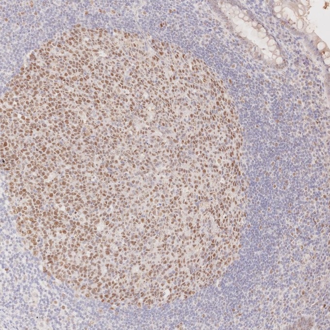 Immunohistochemistry (IHC) staining of human appendicitis tissue using MLH1 Monoclonal antibody (60822-2-Ig)