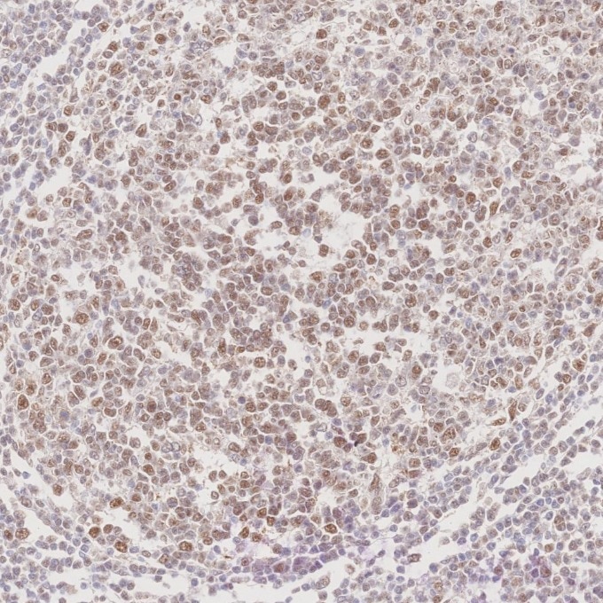 Immunohistochemistry (IHC) staining of human tonsillitis tissue using MLH1 Monoclonal antibody (60822-2-Ig)