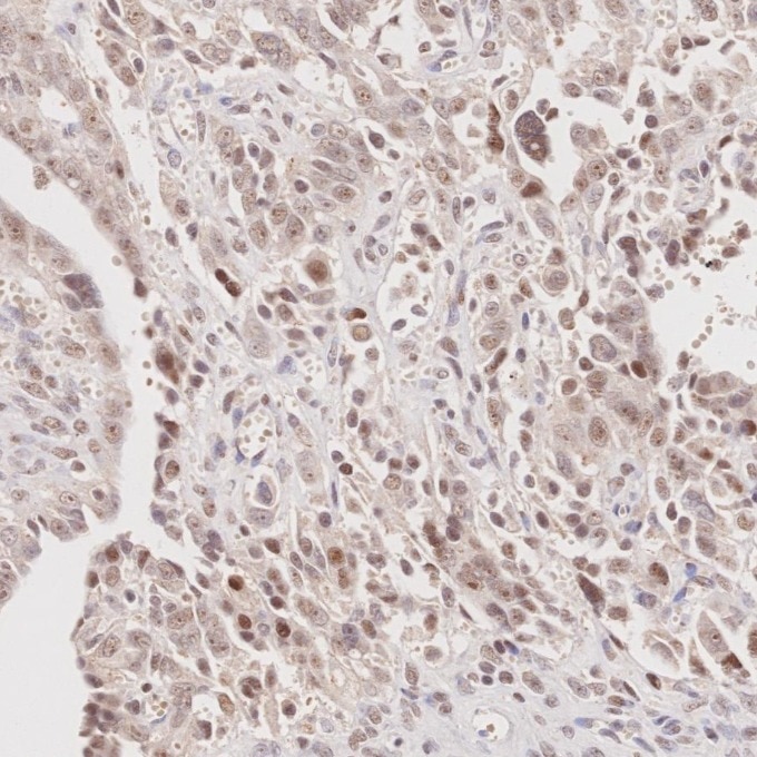 Immunohistochemistry (IHC) staining of human ovary cancer tissue using MLH1 Monoclonal antibody (60822-2-Ig)
