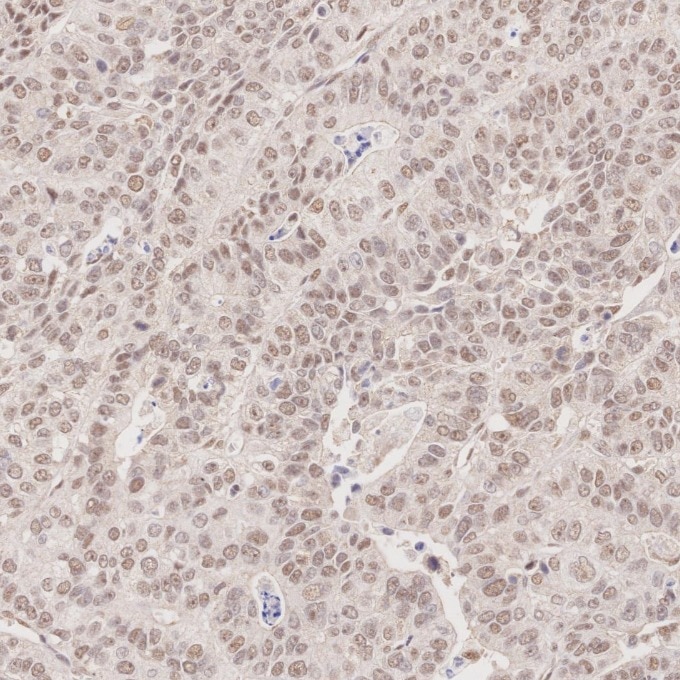 Immunohistochemistry (IHC) staining of human stomach cancer tissue using MLH1 Monoclonal antibody (60822-2-Ig)