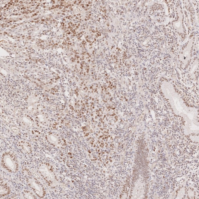 Immunohistochemistry (IHC) staining of human stomach cancer tissue using MLH1 Monoclonal antibody (60822-2-Ig)