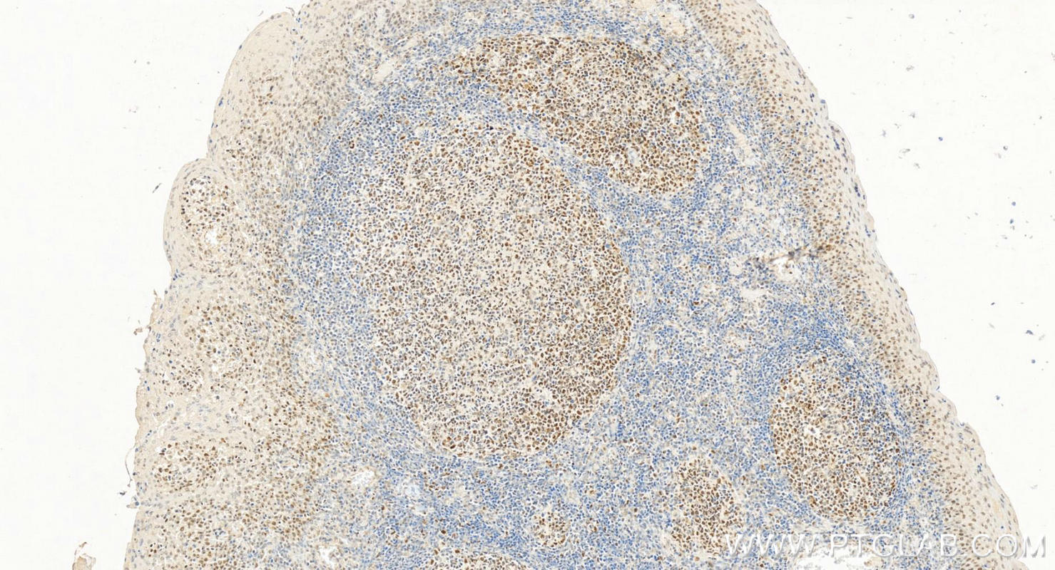 Immunohistochemistry (IHC) staining of Human tonsillitis tissue using MLH1 Monoclonal antibody (60822-2-Ig)