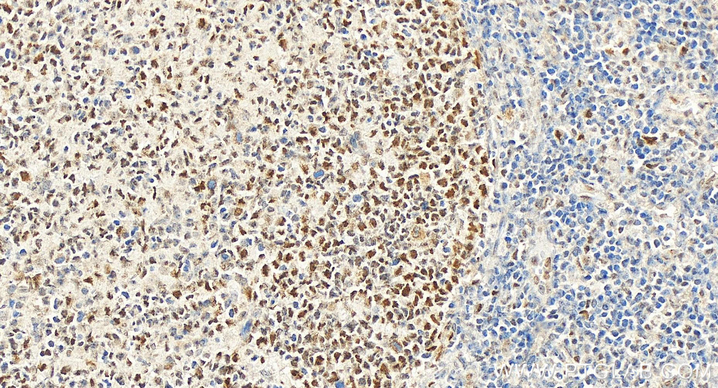 Immunohistochemistry (IHC) staining of Human tonsillitis tissue using MLH1 Monoclonal antibody (60822-2-Ig)