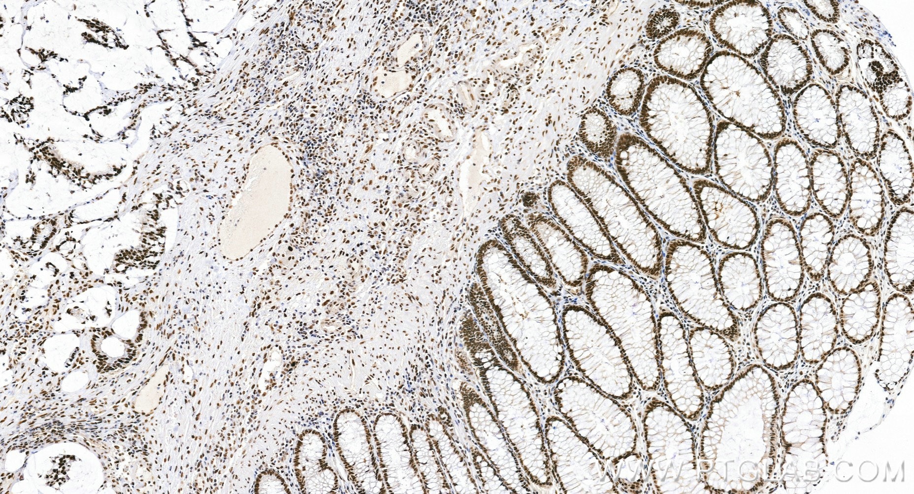 IHC staining of human colon cancer using 84208-7-RR (same clone as 84208-7-PBS) Immunohistochemistry (IHC) staining of human colon cancer tissue using MLH1 Recombinant monoclonal antibody (84208-7-RR)