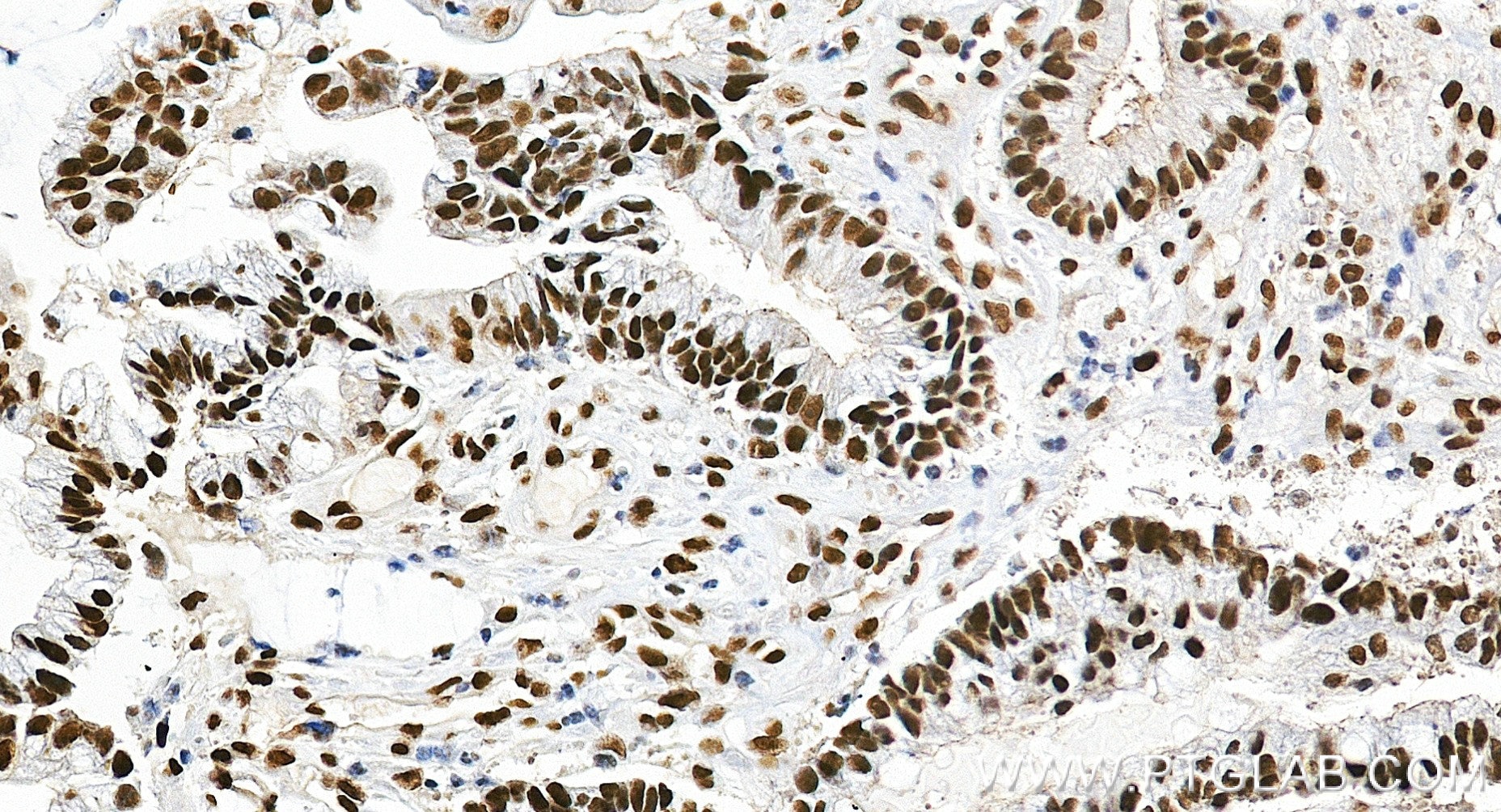 IHC staining of human colon cancer using 84208-7-RR (same clone as 84208-7-PBS) Immunohistochemistry (IHC) staining of human colon cancer tissue using MLH1 Recombinant monoclonal antibody (84208-7-RR)
