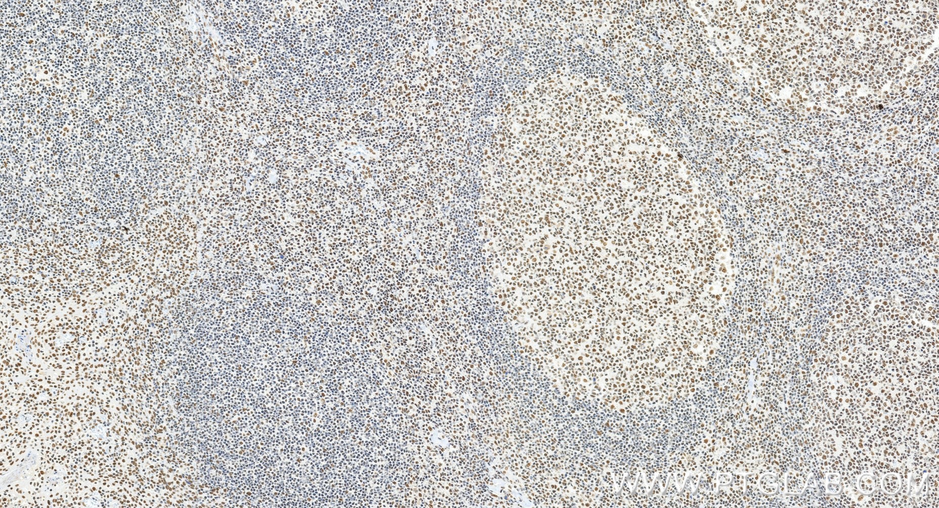 IHC staining of human tonsillitis using 84208-7-RR (same clone as 84208-7-PBS) Immunohistochemistry (IHC) staining of human tonsillitis tissue using MLH1 Recombinant monoclonal antibody (84208-7-RR)