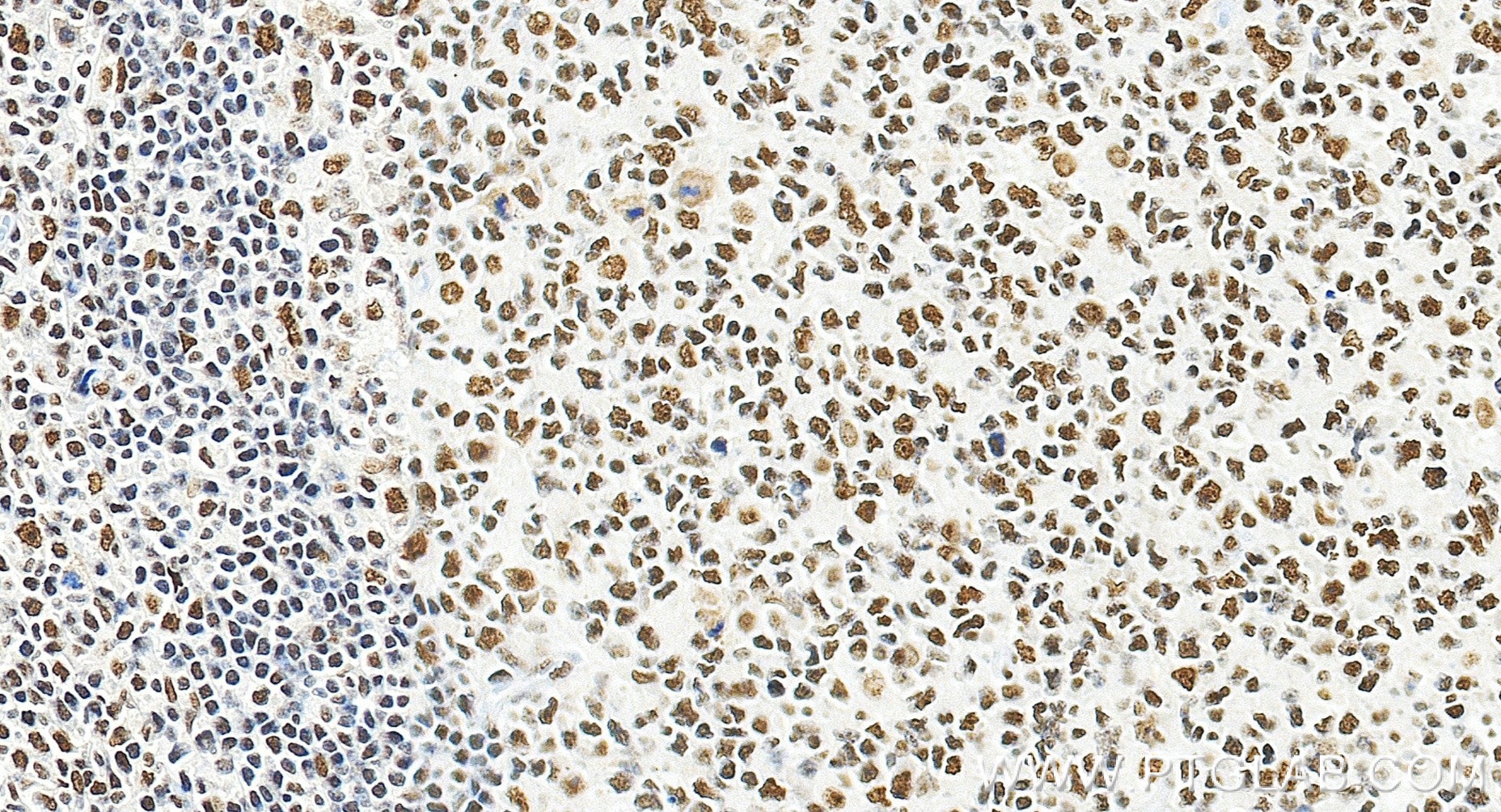 IHC staining of human tonsillitis using 84208-7-RR (same clone as 84208-7-PBS) Immunohistochemistry (IHC) staining of human tonsillitis tissue using MLH1 Recombinant monoclonal antibody (84208-7-RR)